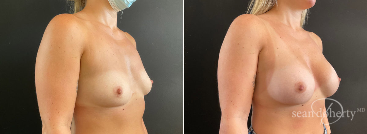 Breast Augmentation Before and After Photos in Boston, MA, Patient 8828