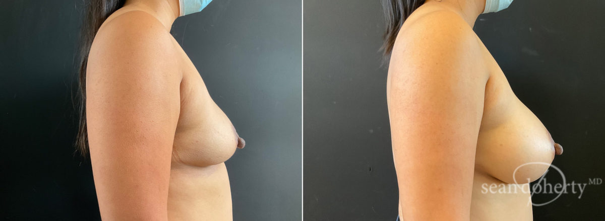 Breast Augmentation Before and After Photos in Boston, MA, Patient 8850