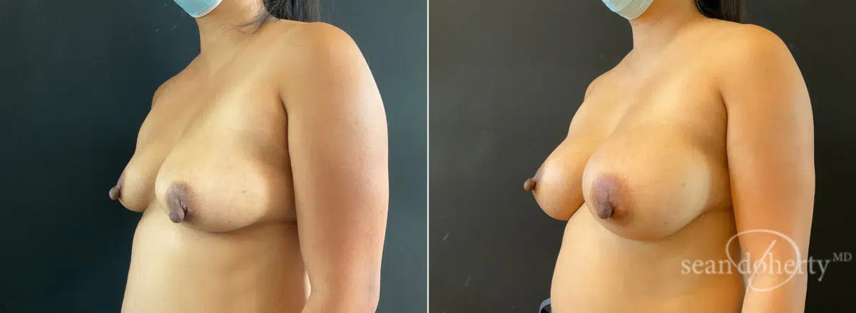 Breast Augmentation Before and After Photos in Boston, MA, Patient 8850