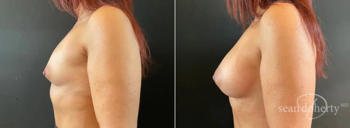 Breast Augmentation Before and After Photos in Boston, MA, Patient 8860