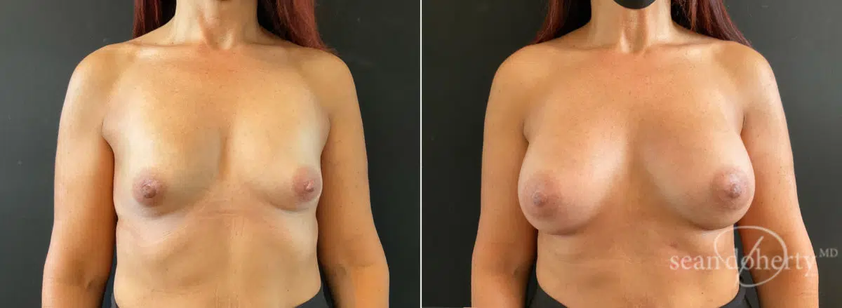 Breast Augmentation Before and After Photos in Boston, MA, Patient 8860