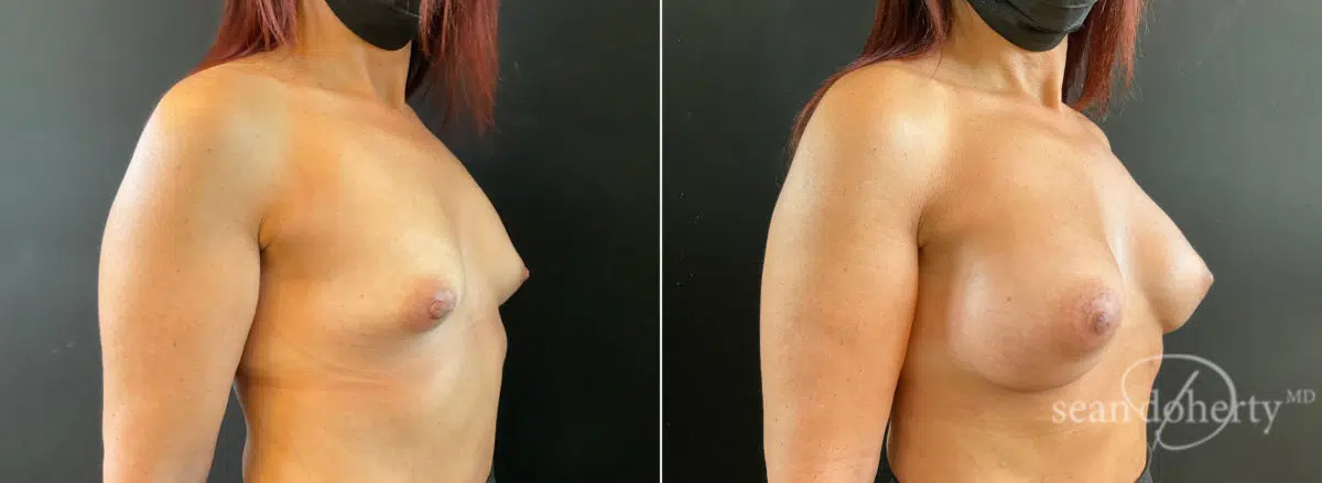 Breast Augmentation Before and After Photos in Boston, MA, Patient 8860