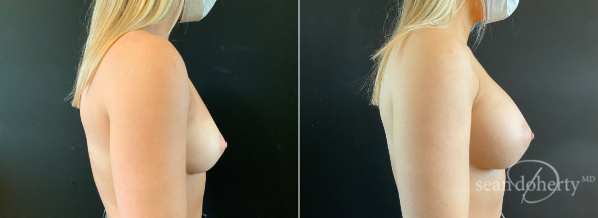 Breast Augmentation Before and After Photos in Boston, MA, Patient 8926