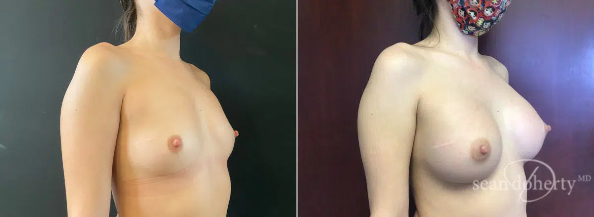 Breast Augmentation Before and After Photos in Boston, MA, Patient 8952