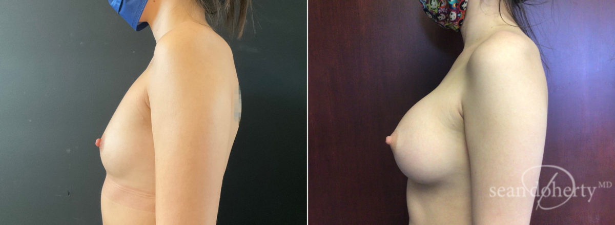 Breast Augmentation Before and After Photos in Boston, MA, Patient 8952