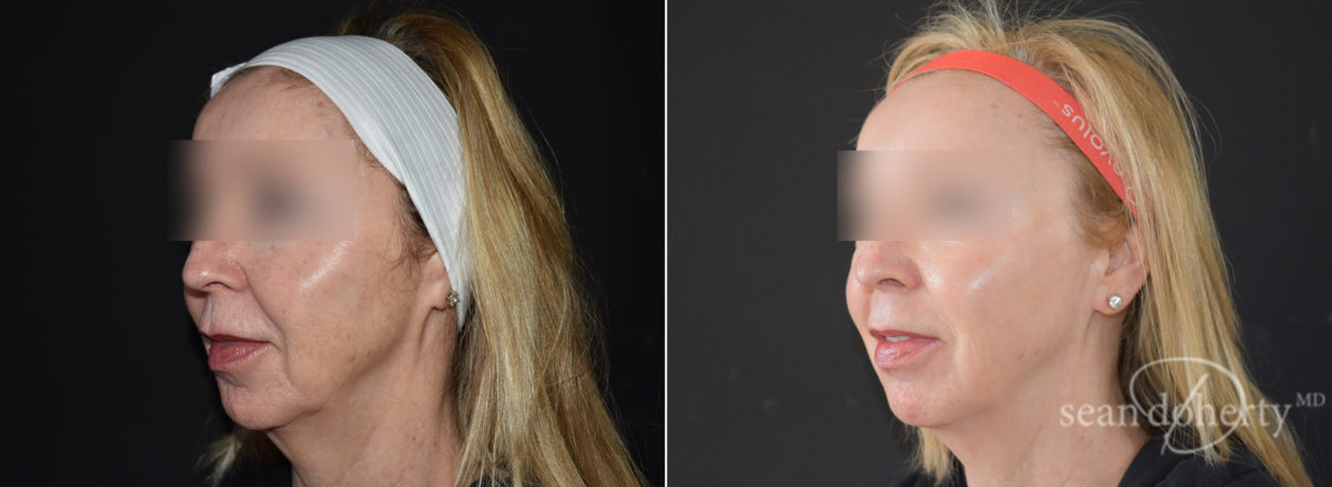 Ablative Laser Before and After Photos in Boston, MA, Patient 9080