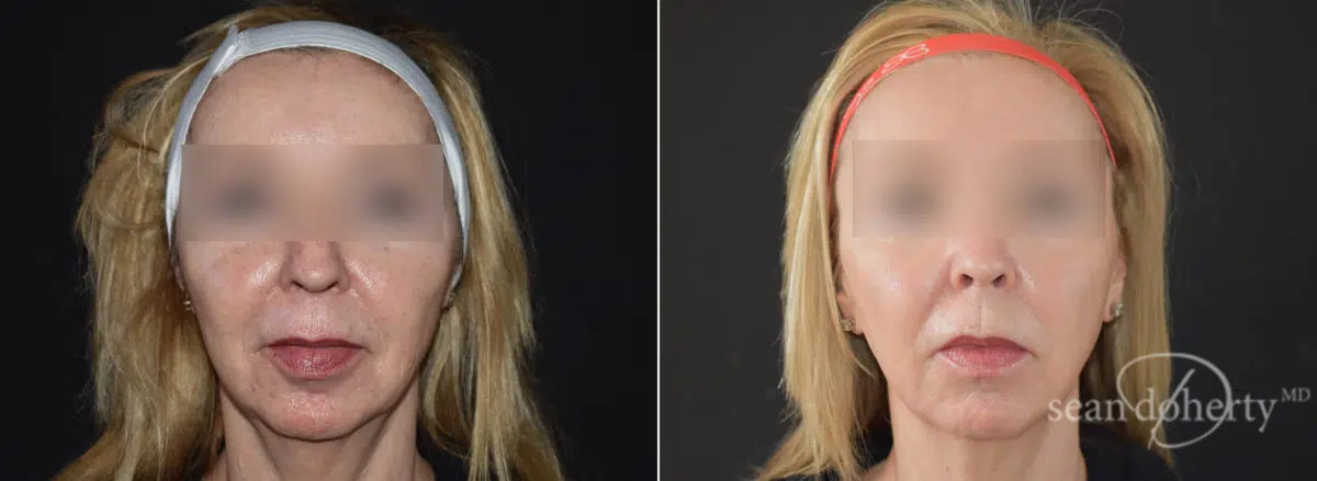 Ablative Laser Before and After Photos in Boston, MA, Patient 9080