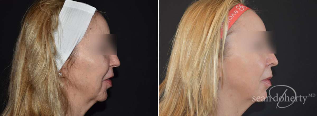 Ablative Laser Before and After Photos in Boston, MA, Patient 9080