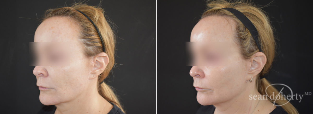 Ablative Laser Before and After Photos in Boston, MA, Patient 9090