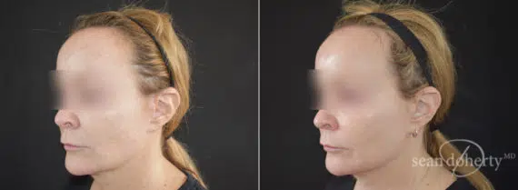 Ablative Laser Before and After Photos in Boston, MA, Patient 9090