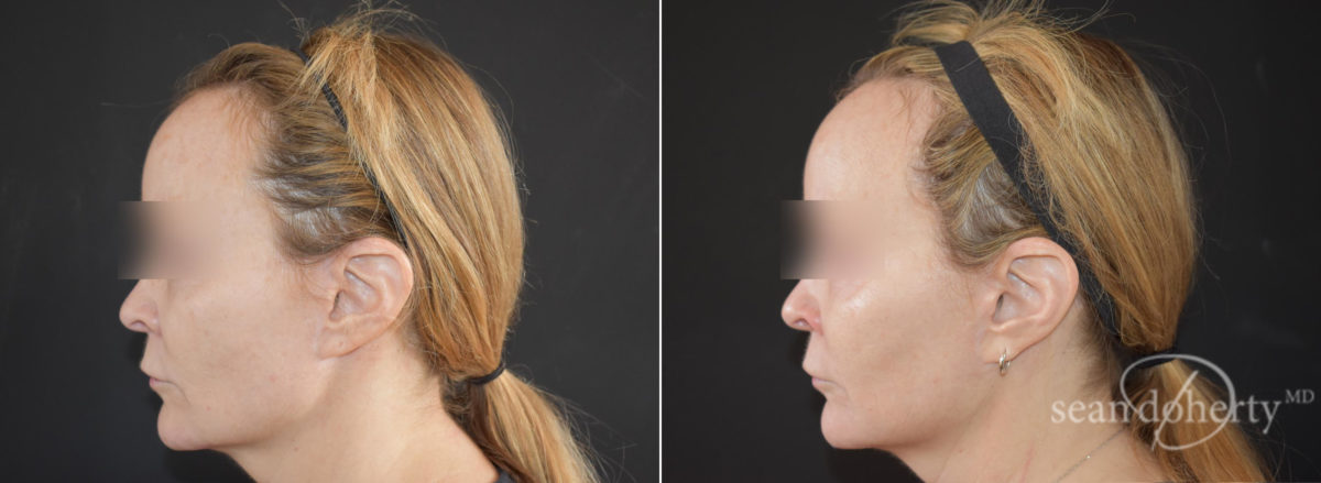 Ablative Laser Before and After Photos in Boston, MA, Patient 9090