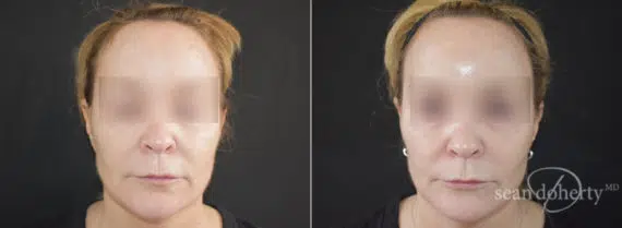 Ablative Laser Before and After Photos in Boston, MA, Patient 9090