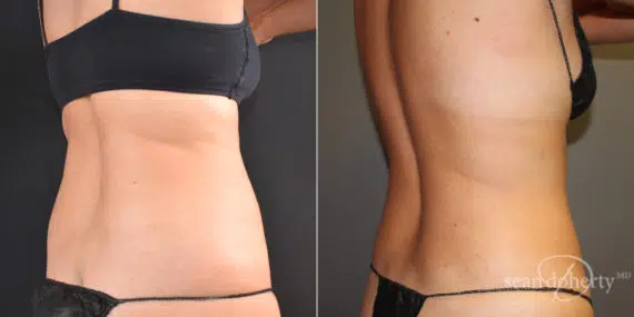 Liposuction Before and After Photos in Boston, MA, Patient 9100