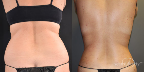 Liposuction Before and After Photos in Boston, MA, Patient 9100