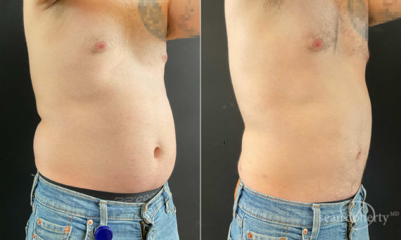 Liposuction Before and After Photos in Boston, MA, Patient 9111