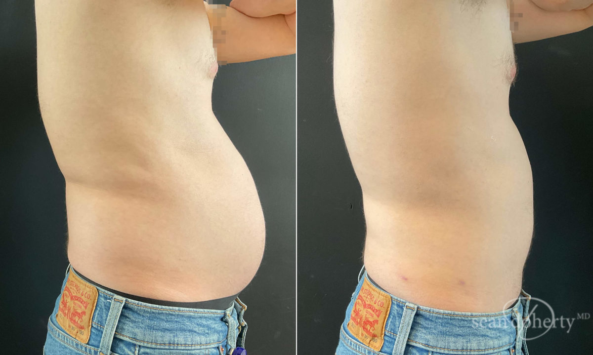 Liposuction Before and After Photos in Boston, MA, Patient 9111