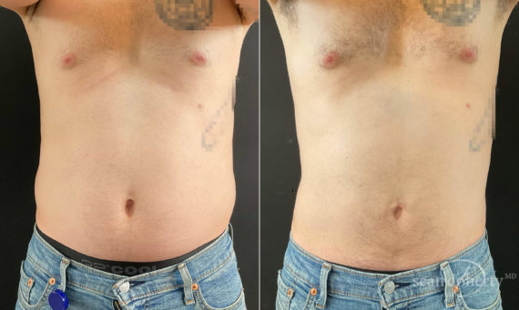 Liposuction Before and After Photos in Boston, MA, Patient 9111