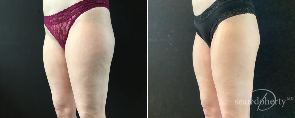 Liposuction Before and After Photos in Boston, MA, Patient 9112