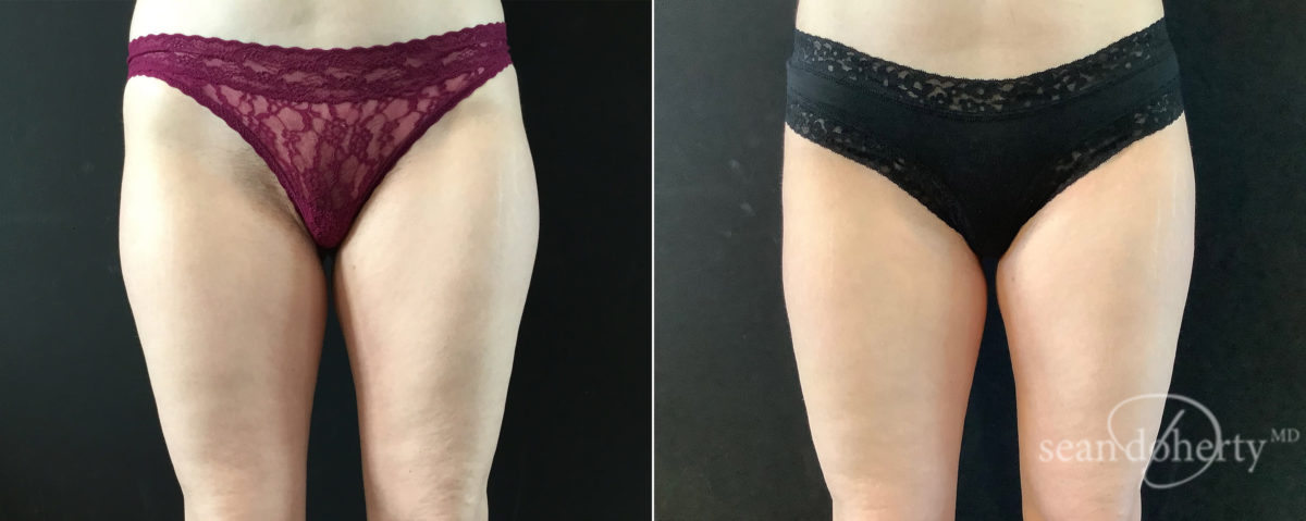 Liposuction Before and After Photos in Boston, MA, Patient 9112