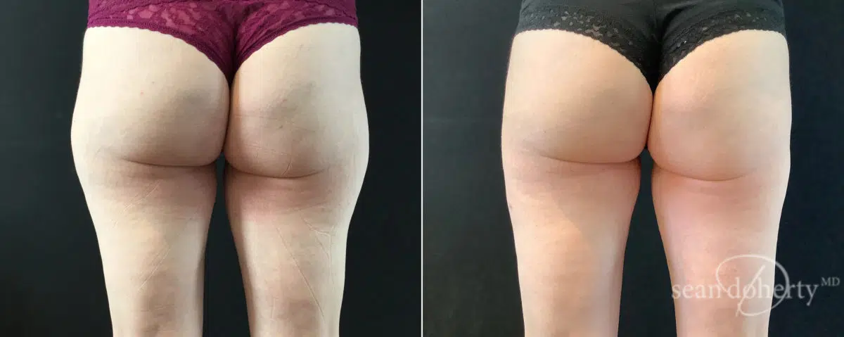 Liposuction Before and After Photos in Boston, MA, Patient 9112