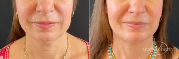 Liposuction Before and After Photos in Boston, MA, Patient 9131