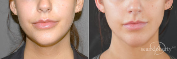 Liposuction Before and After Photos in Boston, MA, Patient 9142