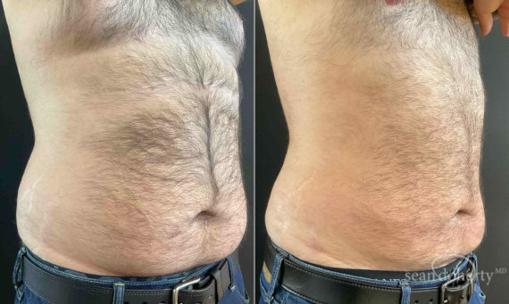 Liposuction Before and After Photos in Boston, MA, Patient 9152