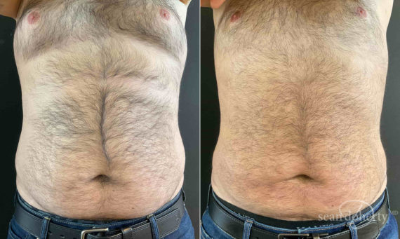 Liposuction Before and After Photos in Boston, MA, Patient 9152