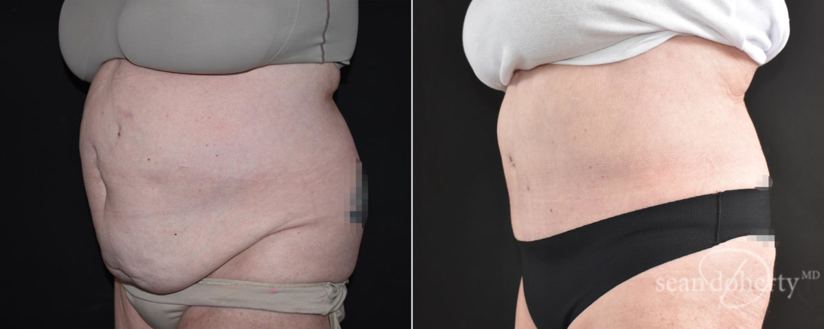 Tummy Tuck Before and After Photos in Boston, MA, Patient 9163