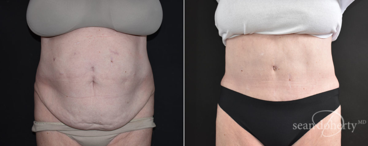 Tummy Tuck Before and After Photos in Boston, MA, Patient 9163