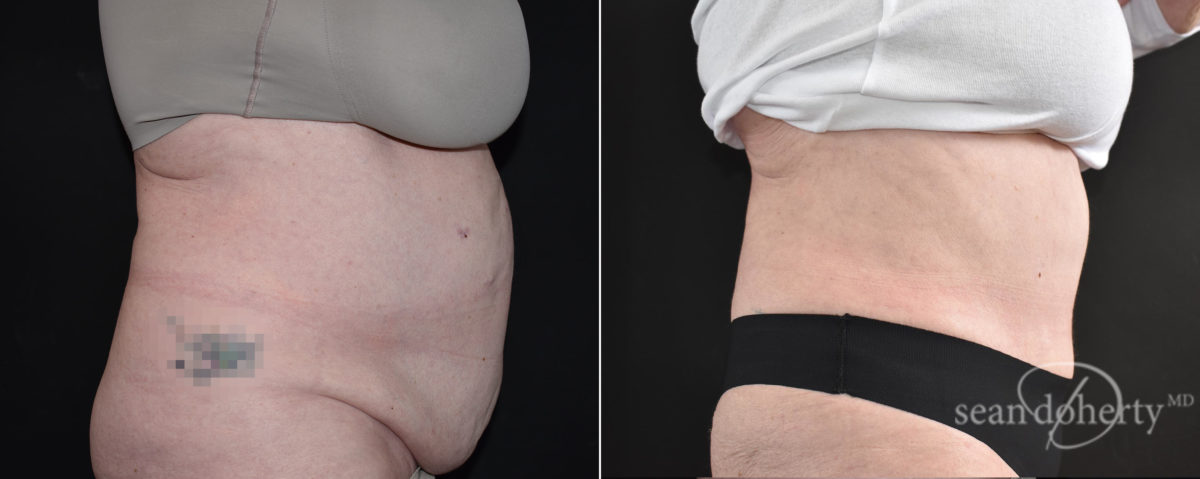 Tummy Tuck Before and After Photos in Boston, MA, Patient 9163