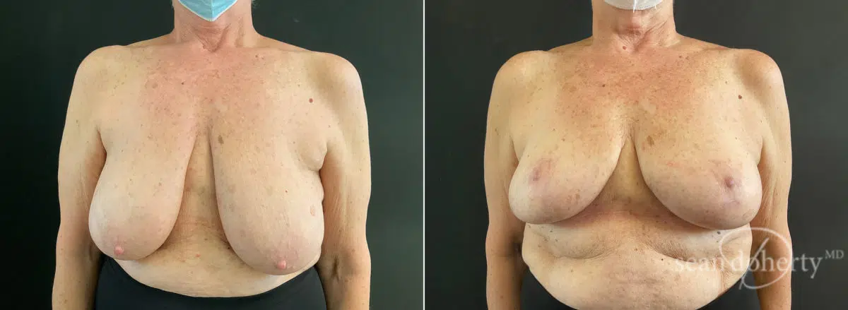 Breast Lift Before and After Photos in Boston, MA, Patient 9173