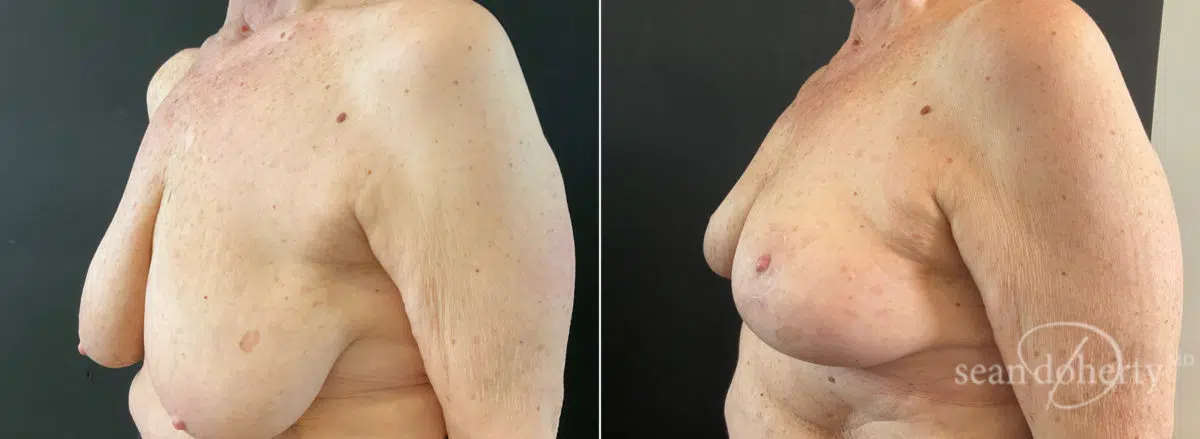 Breast Lift Before and After Photos in Boston, MA, Patient 9173