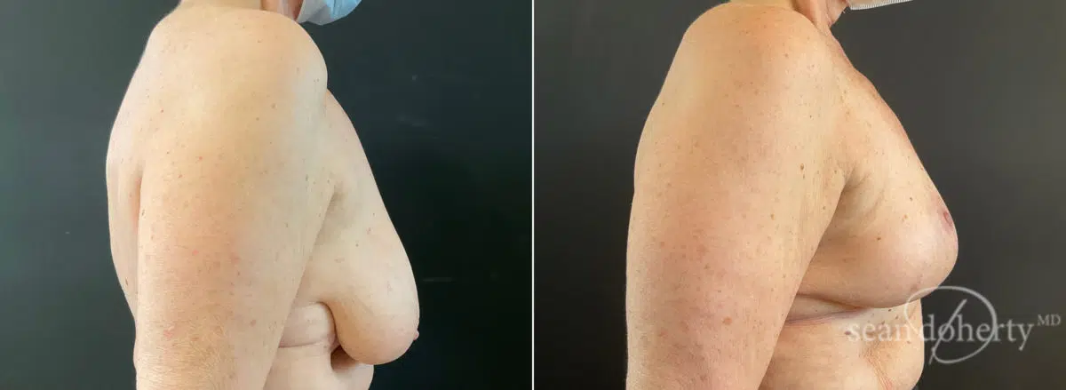 Breast Lift Before and After Photos in Boston, MA, Patient 9173