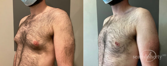 Gynecomastia Before and After Photos in Boston, MA, Patient 9192