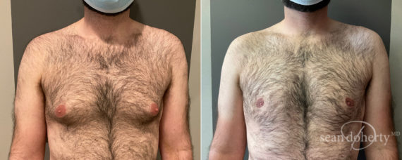 Gynecomastia Before and After Photos in Boston, MA, Patient 9192