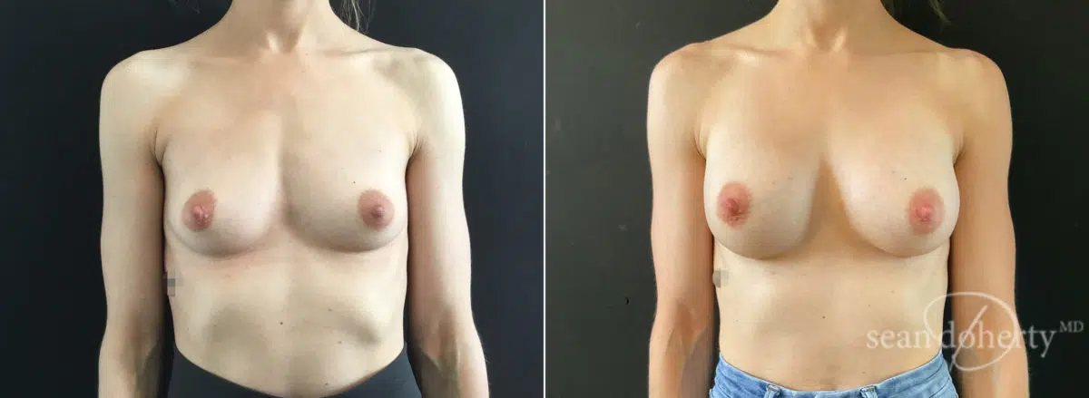 Breast Augmentation Before and After Photos in Boston, MA, Patient 9202