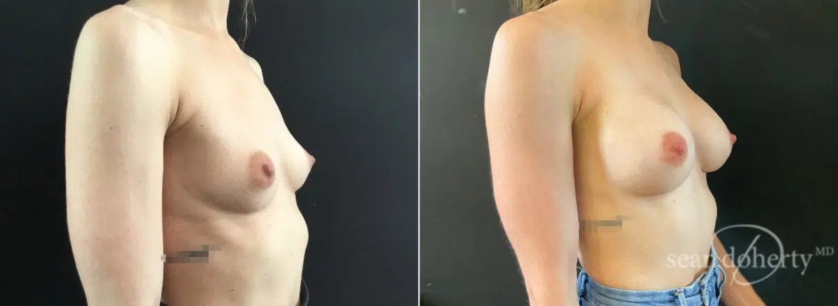 Breast Augmentation Before and After Photos in Boston, MA, Patient 9202