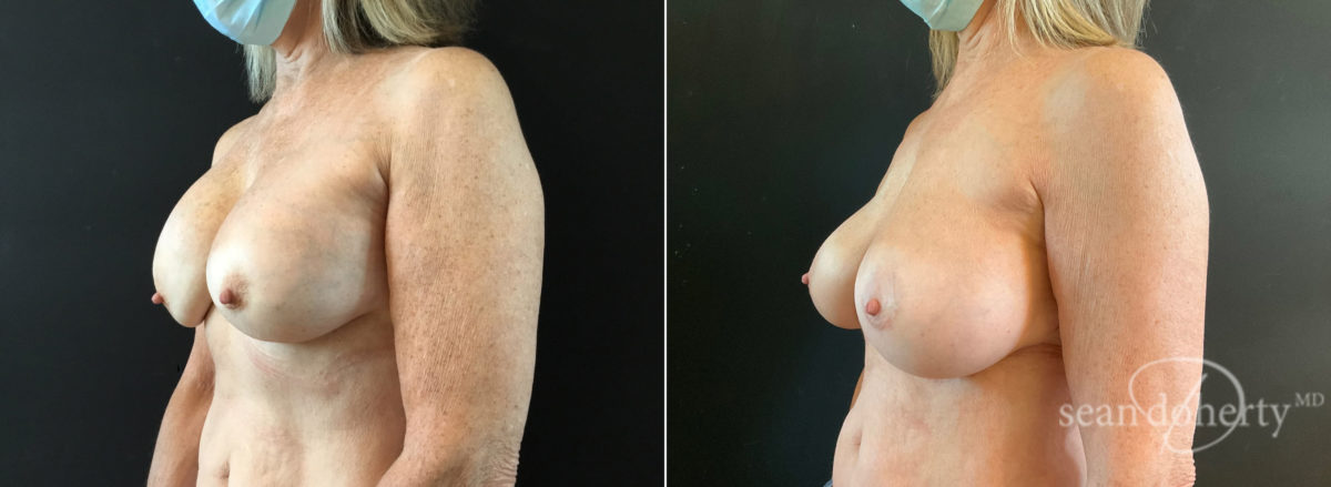 Breast Implant Exchange Before and After Photos in Boston, MA, Patient 8808