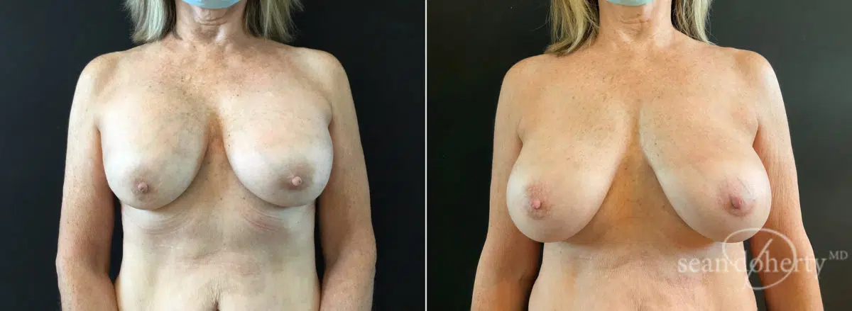 Breast Implant Exchange Before and After Photos in Boston, MA, Patient 8808