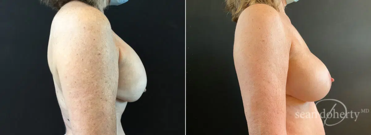 Breast Implant Exchange Before and After Photos in Boston, MA, Patient 8808