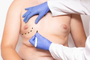 Liposuction or SculpSure for Gynecomastia?