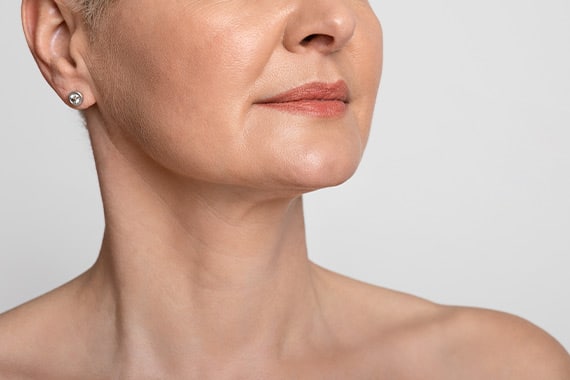 Female patient of Dr. Doherty's who underwent neck liposuction