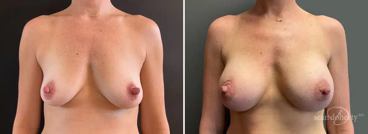 Patient 10098, Breast Augmentation Before and After Photos Breast Augmentation Before and After Photos in Boston, MA, Patient 10098