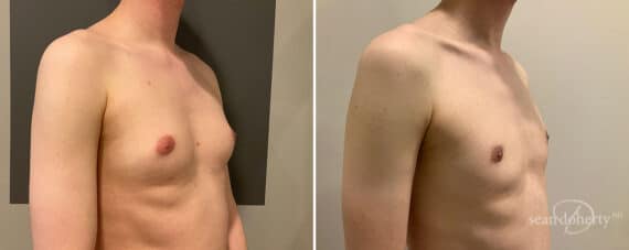 Gynecomastia Before and After Photos in Boston, MA, Patient 10142