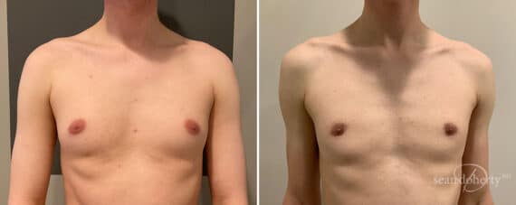 Gynecomastia Before and After Photos in Boston, MA, Patient 10142