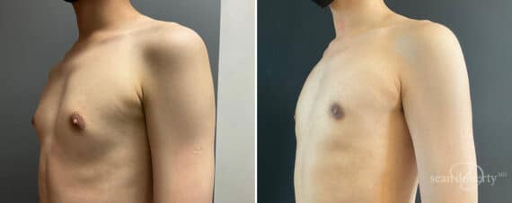 Gynecomastia Before and After Photos in Boston, MA, Patient 10154