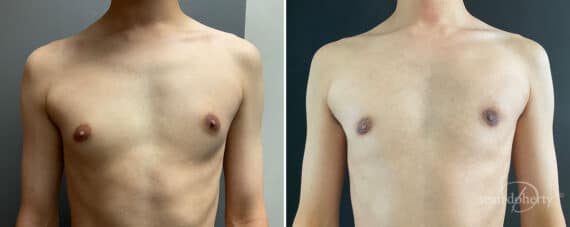 Gynecomastia Before and After Photos in Boston, MA, Patient 10154