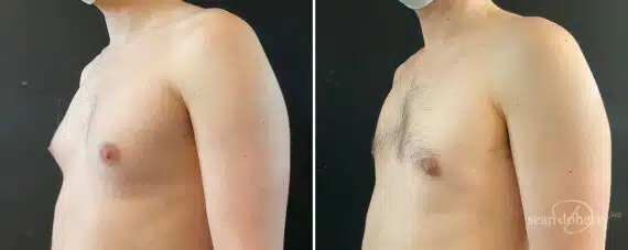 Gynecomastia Before and After Photos in Boston, MA, Patient 10164