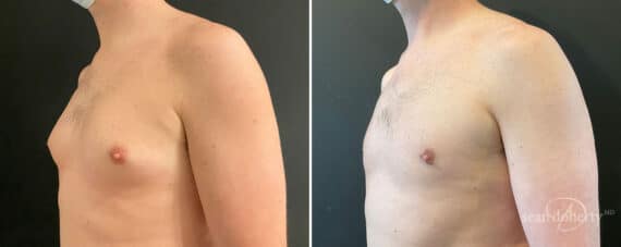 Gynecomastia Before and After Photos in Boston, MA, Patient 10179